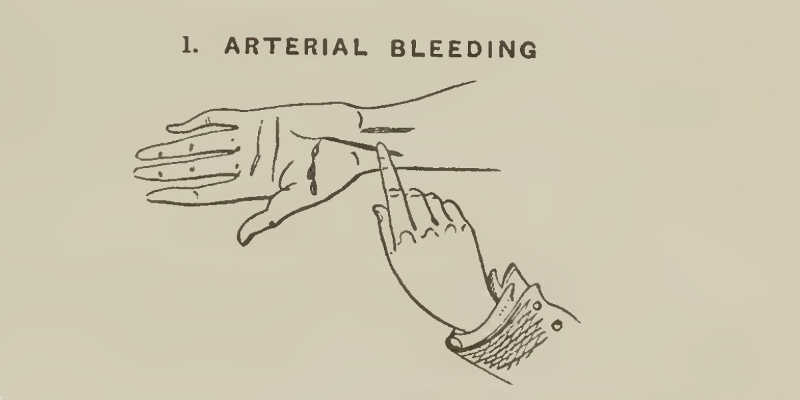 Arterial Bleeding Pressure