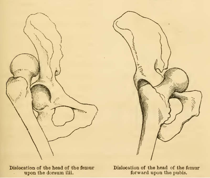 Dislocation of the Head of the Femur